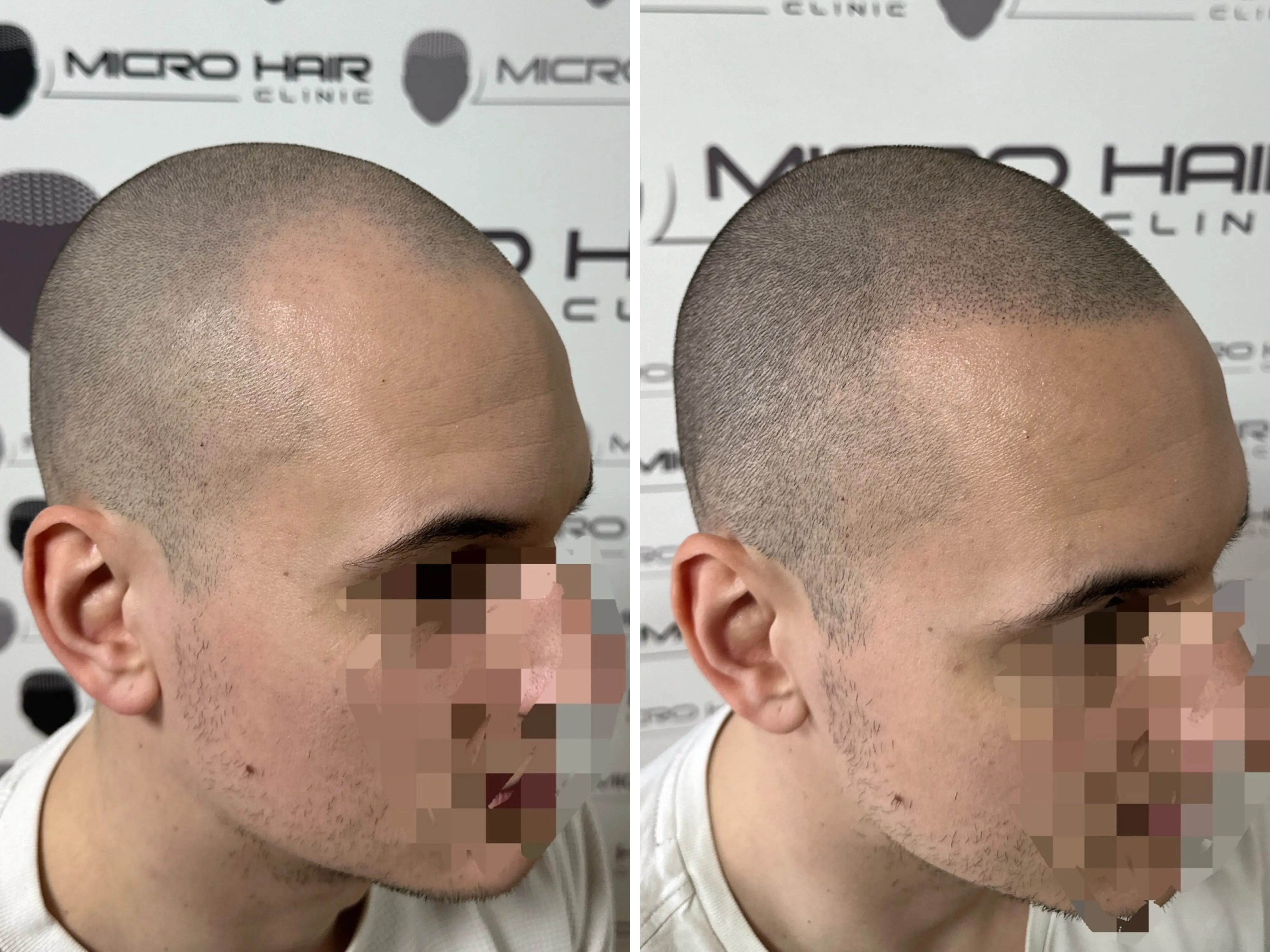 SMP rezultat pred in po - tretman mikropigmentacije 2